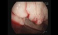 Resaignement de Varice Fundique - Cyanoacrylate + AB-Gel Injection 