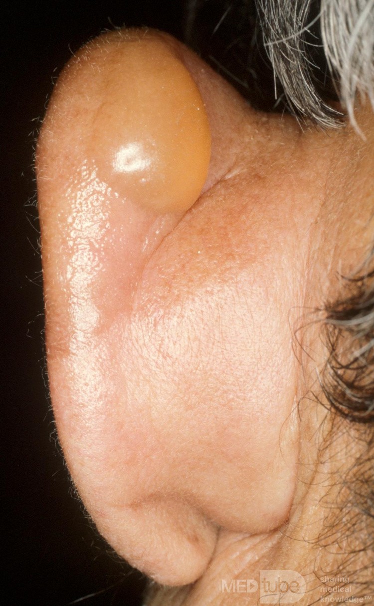 Gelure