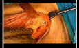 Histoire de la chirurgie du cancer du sein (Voyage de la mutilation à la chirurgie d'embellissement)