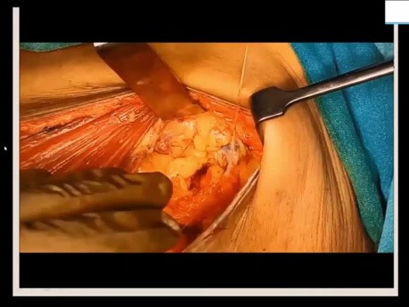 Histoire de la chirurgie du cancer du sein (Voyage de la mutilation à la chirurgie d'embellissement)