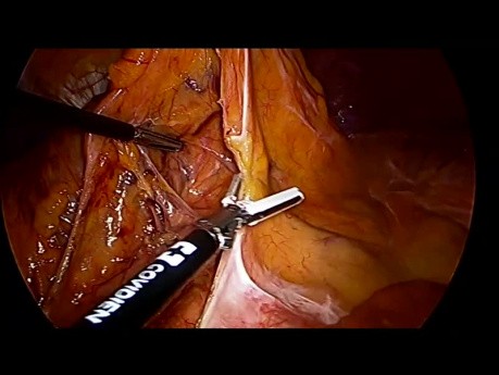 Proctocolectomie TaTME (excision mésorectale totale transanale) par laparoscopie