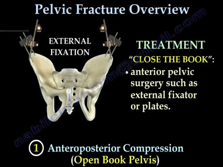 Fractures pelviennes - conférence vidéo