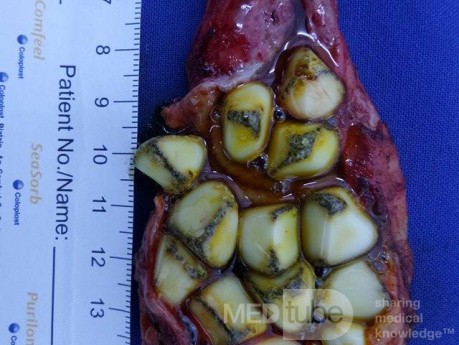 La cholécystectomie laparoscopique, la présence des plusieurs calculs dans la vésicule biliaire.