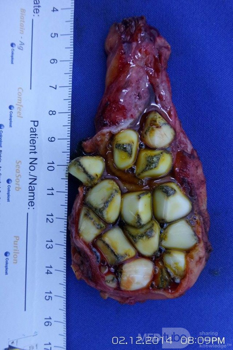 La cholécystectomie laparoscopique, la présence des plusieurs calculs dans la vésicule biliaire.