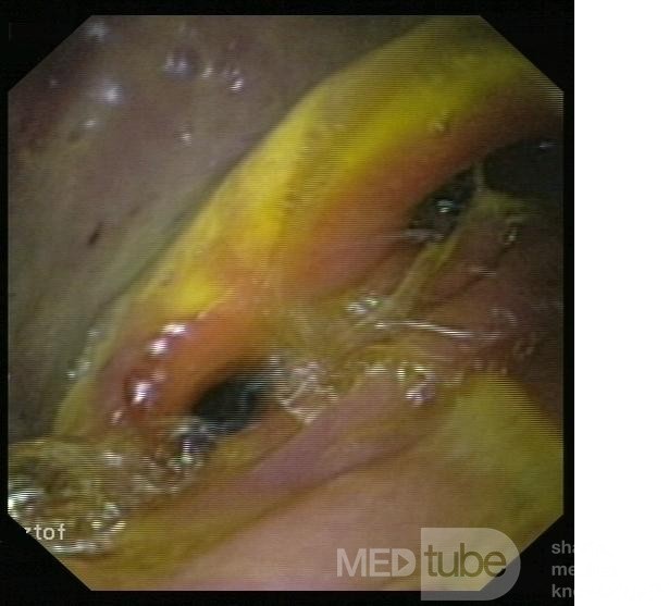 L'état après résection B2 - vue endoscopique.