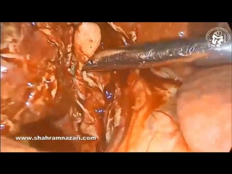 Cholécystectomie Laparoscopique pour Cholécystite Gangréneuse