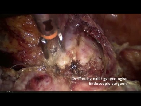 Abdomen Cicatriciel. Obésité Morbide. Hystérectomie Complexe.