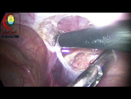 Déconnexion du Sac Herniaire du Péritoine dans une Hernie Inguinale Coexistant avec une Hydrocèle Communicante Ipsilatérale chez un Garçon de 7 ans