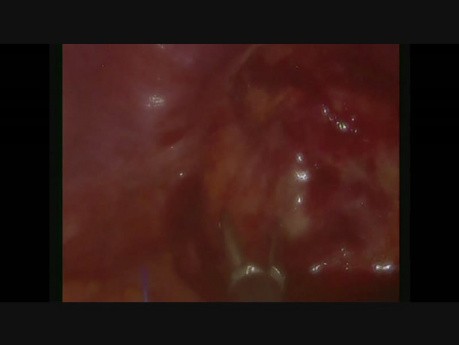 le SILS  (chirurgie laparoscopique mono-incisionnelle)- reconstruction de la continuité du tube digestif. 