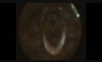 Granulome d'intubation