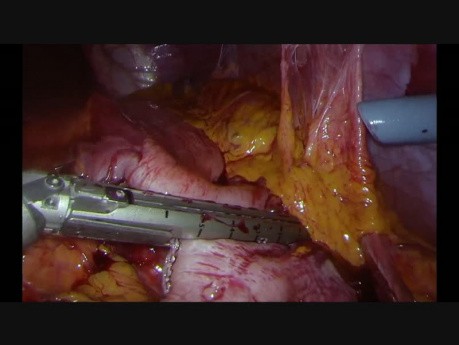 Gastrectomie laparoscopique totale.