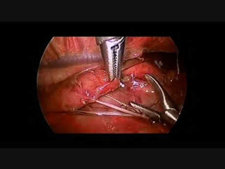 Réparation Thoracoscopique d'Atrésie Oesophagienne