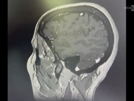 Résection de Ménigome du Tubercule de la Selle Turcique