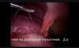 Chirurgie Laparoscopique pour un Ulcère Gastroduodénal Perforé