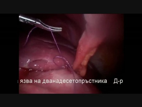 Chirurgie Laparoscopique pour un Ulcère Gastroduodénal Perforé