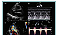 Échocardiographie dans la cardiomyopathie hypertrophique