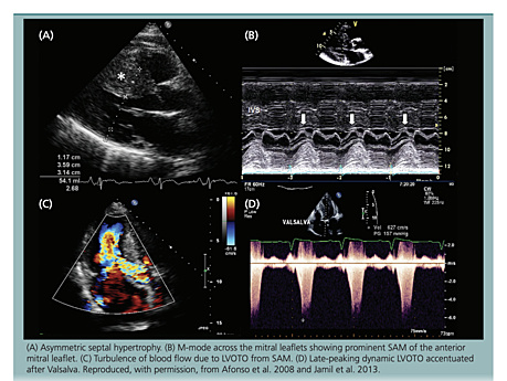 Échocardiographie dans la cardiomyopathie hypertrophique