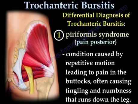 Bursite trochantérienne - Présentation et Traitement