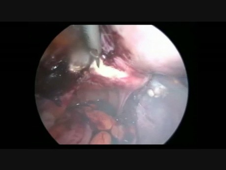 Hystérectomie laparoscopique