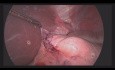 Chirurgie de Préservation d'Organe dans le cas d'une Tumeur de l'œsophage Abdominal