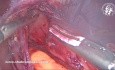 Lipome Médiastinal Incidentel Lors d'une Fundoplicature de Nissen Laparoscopique. Quelle est la Stratégie Chirurgicale ?