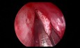 Septoplastie Endoscopique pour Déviation de la Cloison Nasale