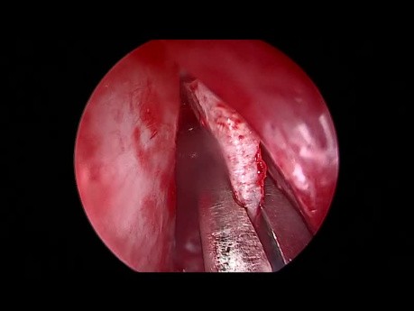 Septoplastie Endoscopique pour Déviation de la Cloison Nasale