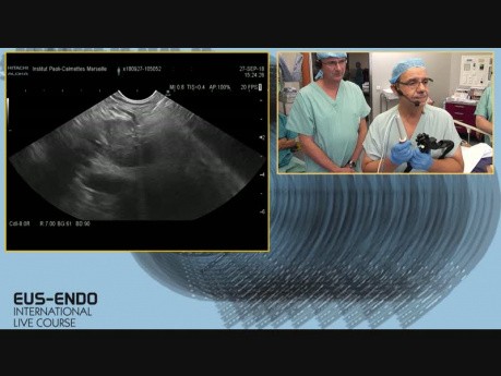 Ablation par radiofréquence de la métastase pancréatique guidée par l'échographie endoscopique