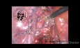 Cholécystectomie laparoscopique et exploration des voies biliaires communes