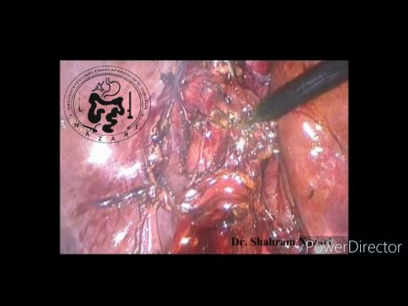 Cholécystectomie laparoscopique et exploration des voies biliaires communes