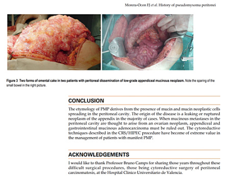 Pseudomyxome péritonéal - Publication sur les concepts historiques de cette maladie WJGS