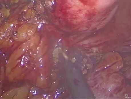  Diverticulite Compliquée de Fistule Colo-Vésicale - Traitement Laparoscopique