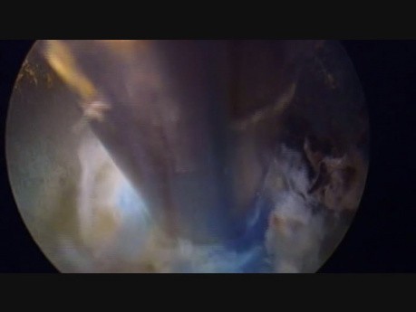 Intervention PELAN L4 Gauche, Chirurgie Endoscopique de la Colonne Vertébrale