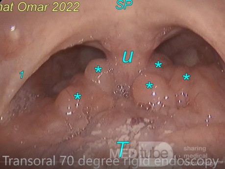 Hypertrophie des amygdales • Site médical MEDtube.fr