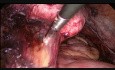  Prolapsus du Dôme Vaginal 