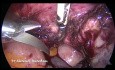 Hystérectomie laparoscopique totale
