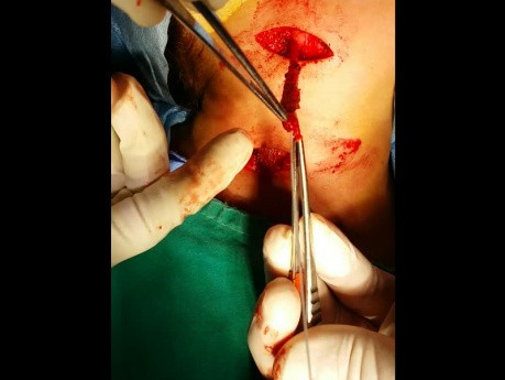 Opération de la fistule branchiale avec incision en deux étapes
