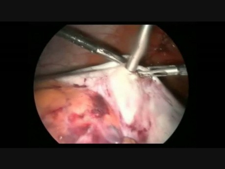 Une tumeur de l'ovaire - prise en charge laparoscopique