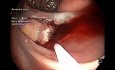 Dissection Sous-Muqueuse/ Mucosectomie Hybride avec Incision Semi-Circonférentielle, Hémorragie et Clips dans le Côlon Ascendant