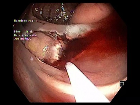 Dissection Sous-Muqueuse/ Mucosectomie Hybride avec Incision Semi-Circonférentielle, Hémorragie et Clips dans le Côlon Ascendant