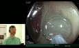 La dissection sous-muqueuse endoscopique (ESD) de l'adénome rectal - Michał Spychalski