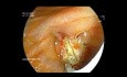 Ampullectomie - Ictère Obstructif