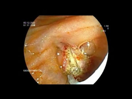 Ampullectomie - Ictère Obstructif