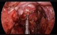 Anastomose intestinale - utilisation du vert d'indocyanine (ICG)
