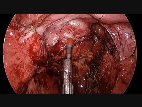 Anastomose intestinale - utilisation du vert d'indocyanine (ICG)
