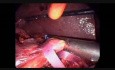 Pancréatoduodénectomie laparoscopique