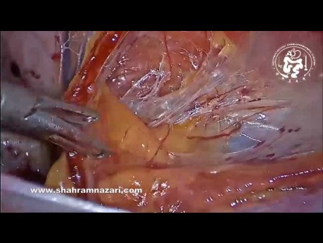 Réduction et Suspension d'un Lipome du Cordon Spermatique