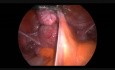 Myome intestinal - l'exérèse laparoscopique
