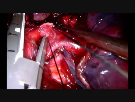 La bilobectomie complexe avec reconstruction bronchique B1-B2-B3 selon la méthode CTVA en utilisant un seul port (CTVA -U)