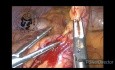 Appendicectomie abdominale dans l'appendicite aiguë